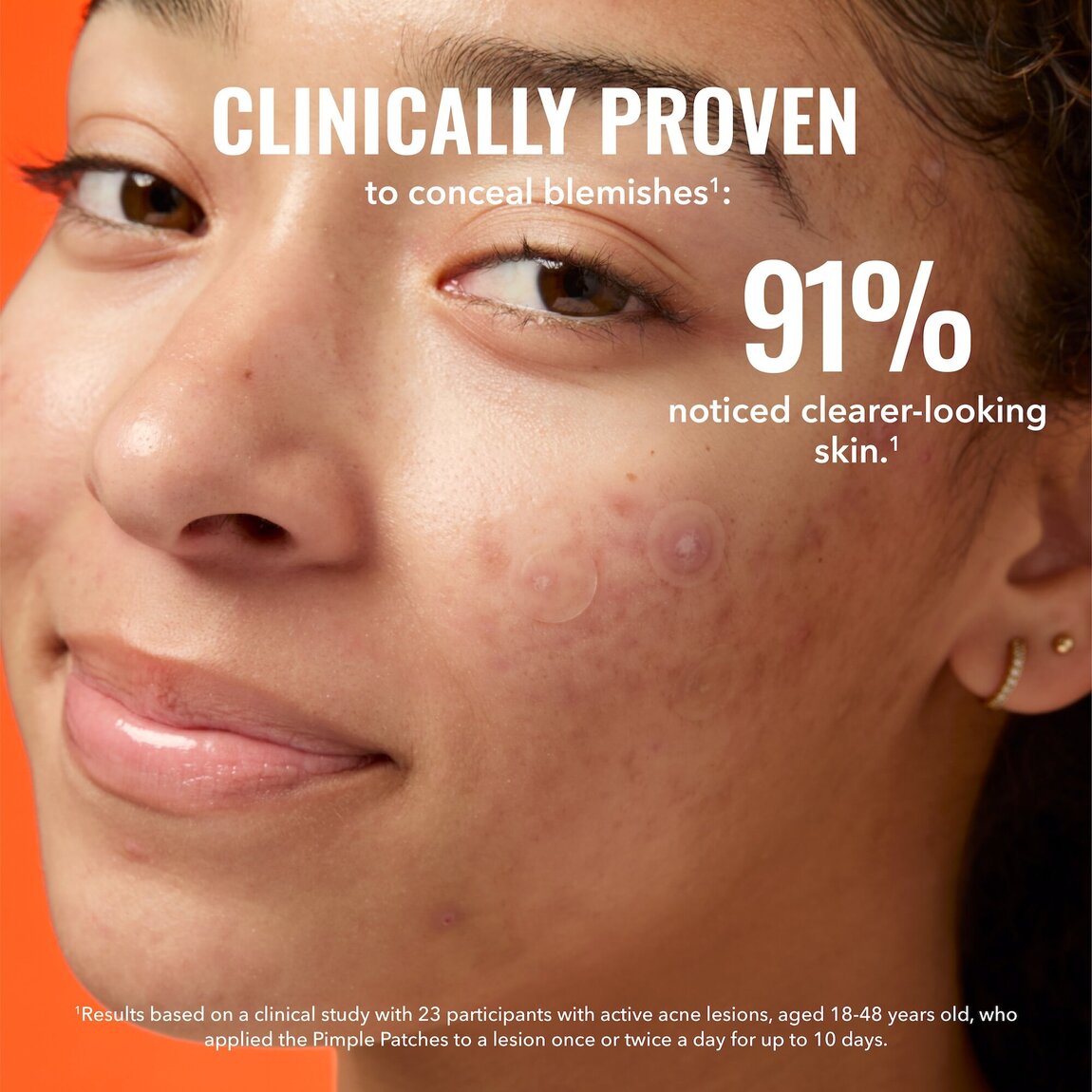 pimple-patches-j8 zb_p.jpg
