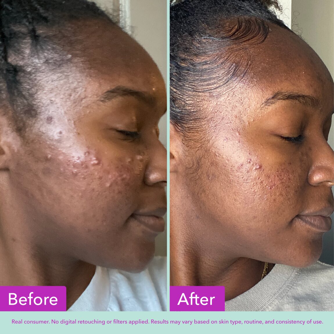 acne-foaming-cleanser-b6 zb_p.jpg